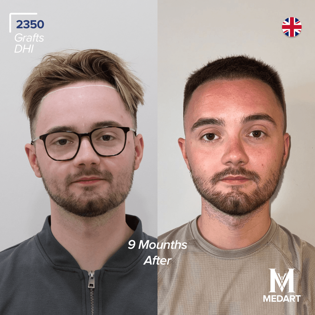 Before After transformation 2